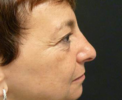 Before Eyelid Surgery Results