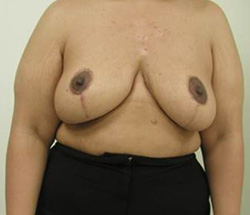 After Breast Augmentation Results