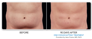 CoolSculpting Princeton NJ