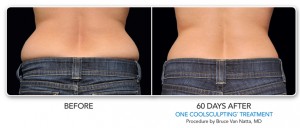 CoolSculpting of Muffin Top