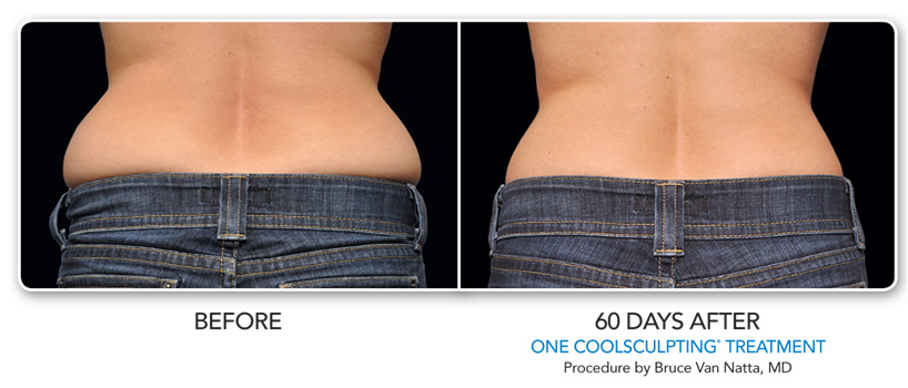 Non Surgical Fat Reduction  CoolSculpting Princeton, NJ