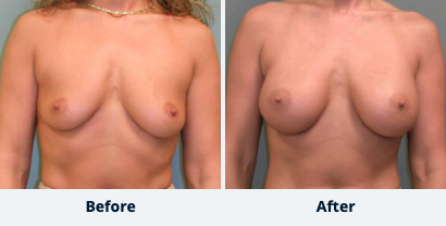 Breast Augmentation Gallery