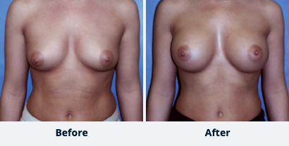 Breast Augmentation Gallery