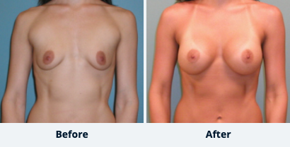 Breast Augmentation Gallery