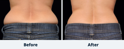 CoolSculpting™ Gallery