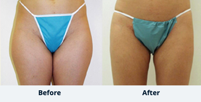 Liposuction Gallery