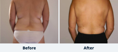 SmartLipo™ Gallery