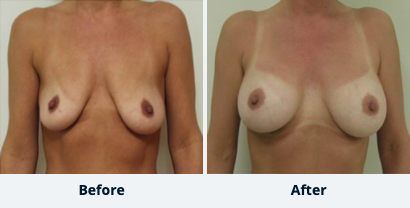 Breast Augmentation Gallery