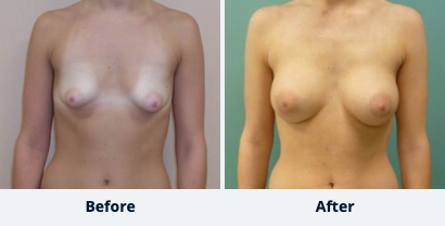 Breast Augmentation Gallery