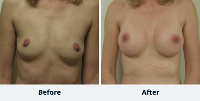 Breast Augmentation Gallery