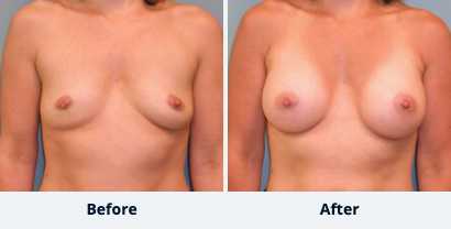 Breast Augmentation Gallery