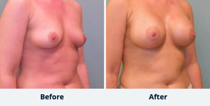 Breast Augmentation Gallery