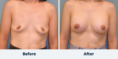 Breast Augmentation Gallery