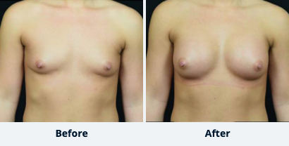 Breast Augmentation Gallery