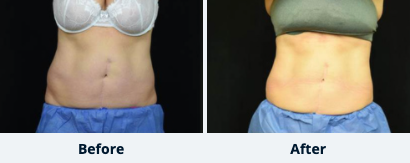 CoolSculpting™ Gallery