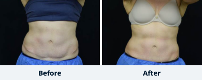 CoolSculpting™ Gallery