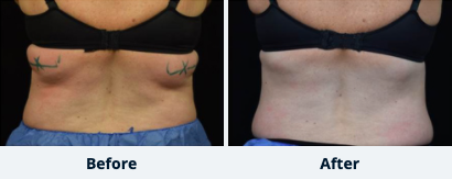 CoolSculpting™ Gallery