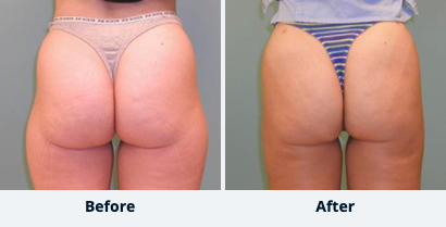 Liposuction Gallery