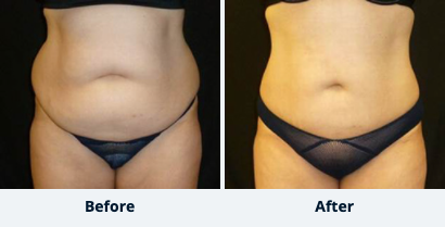 Liposuction Gallery