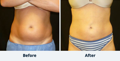 Liposuction Gallery