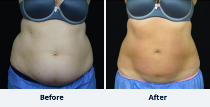 Liposuction Gallery