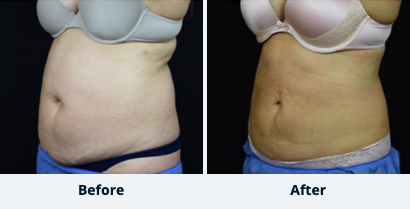 Liposuction Gallery