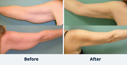 Arm Liposuction