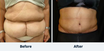 Tummy Tuck Gallery