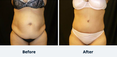 Tummy Tuck Gallery