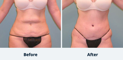 Tummy Tuck Gallery