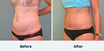 Tummy Tuck Gallery