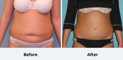 Tummy Tuck Gallery