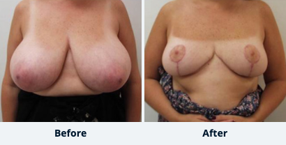 Breast Reduction Gallery