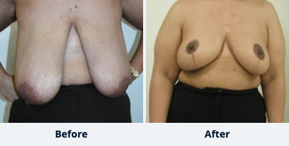 Breast Reduction Gallery