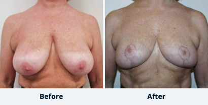 Breast Reduction Gallery