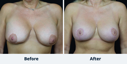 Breast Augmentation Gallery