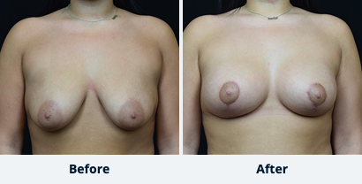 Breast Lift Gallery