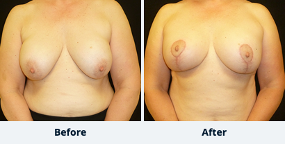 Breast Augmentation Gallery