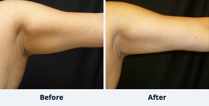 Arm Liposuction