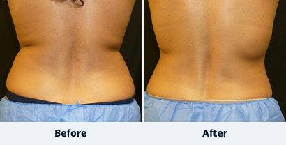 Liposuction Back and Flanks Treatment Gallery in New Bern, NC