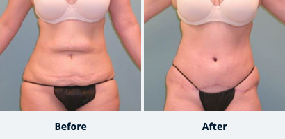 Tummy Tuck (Abdominoplasty)