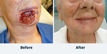 Before and After Reconstructive Surgery