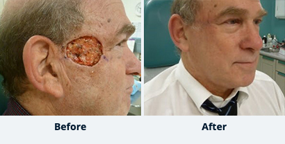 Before and After Reconstructive Surgery