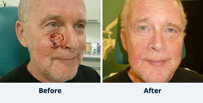 Before and After Reconstructive Surgery