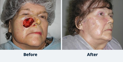 Before and After Reconstructive Surgery