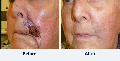 Before and After Reconstructive Surgery