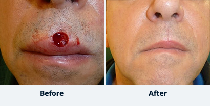 Before and After Reconstructive Surgery