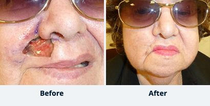 Before and After Reconstructive Surgery