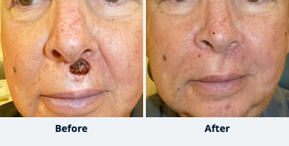 Before and After Reconstructive Surgery