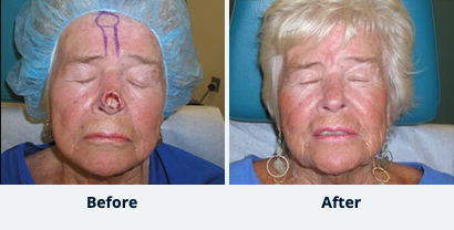 Before and After Reconstructive Surgery